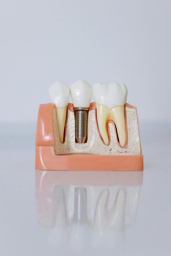 Understanding dental implants: a guide to your options